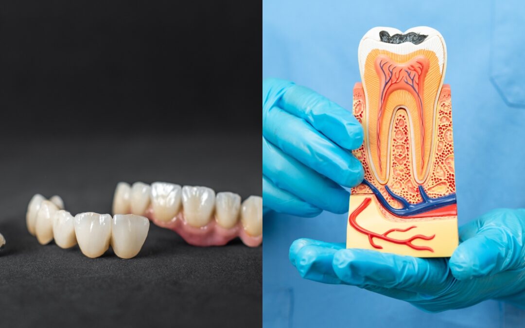 Can You Get a Root Canal and Crown on the Same Day?