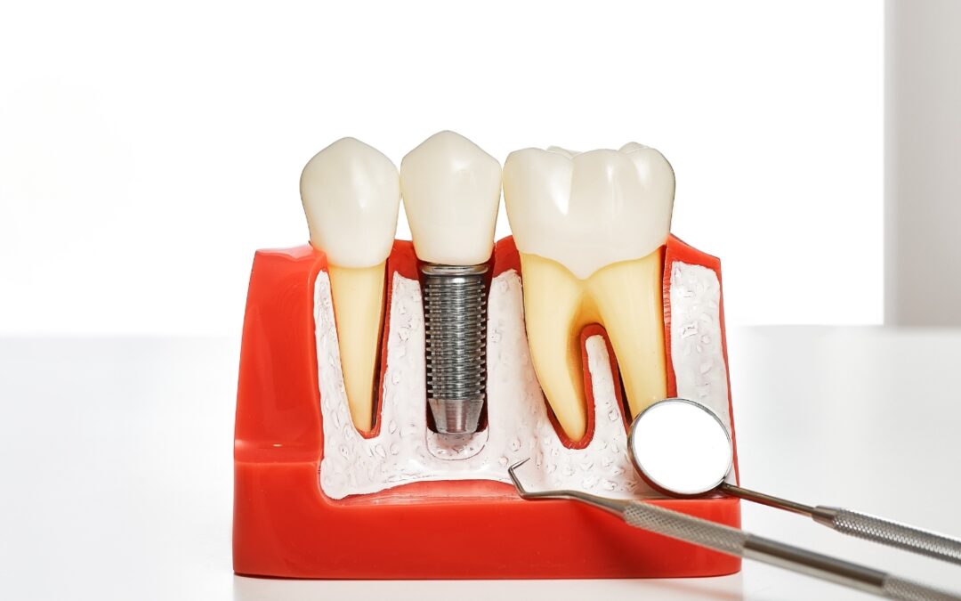 What Are the Signs You May Need Dental Implants?