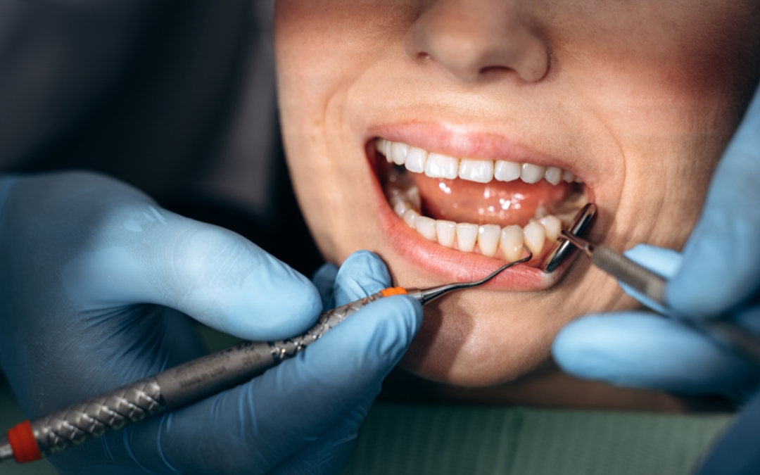 What Is the Best Antibiotic for Gum Infection?