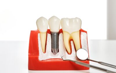 Dental Bone Graft Healing Timeline: What to Expect From Surgery to Implants