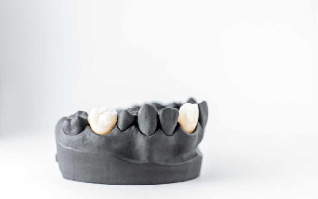 How Does A Dentist Remove A Dental Crown How Does A Dentist Remove A Dental Crown