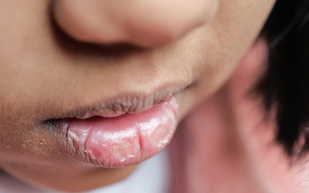 Dry Mouth Relief: The Ultimate Food & Hydration Guide