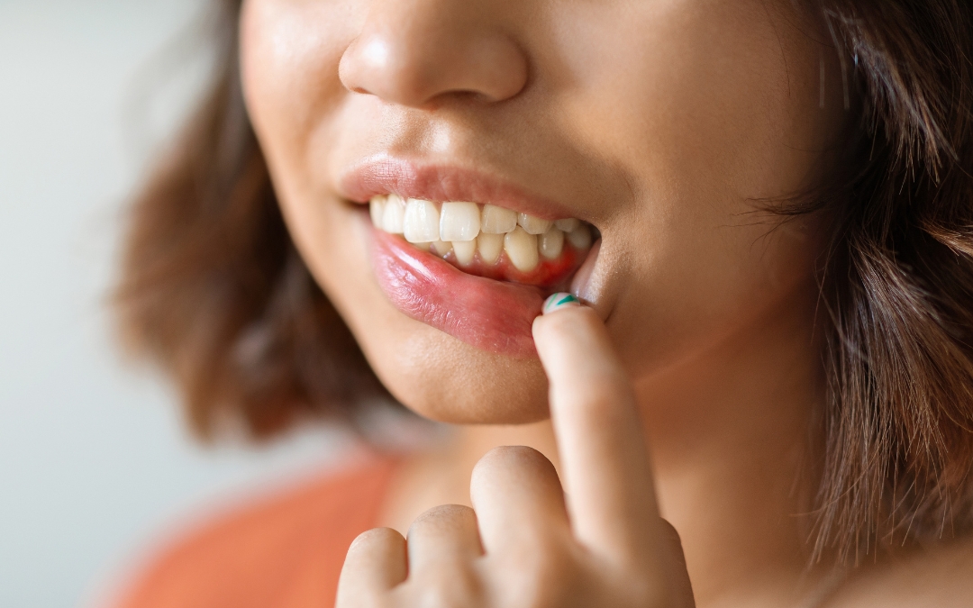 Periodontal Disease: Understanding Stage 4 – Symptoms, Risks, and Treatment Options
