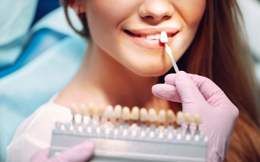 Do Veneers Look Natural on Front Teeth Do Veneers Look Natural on Front Teeth