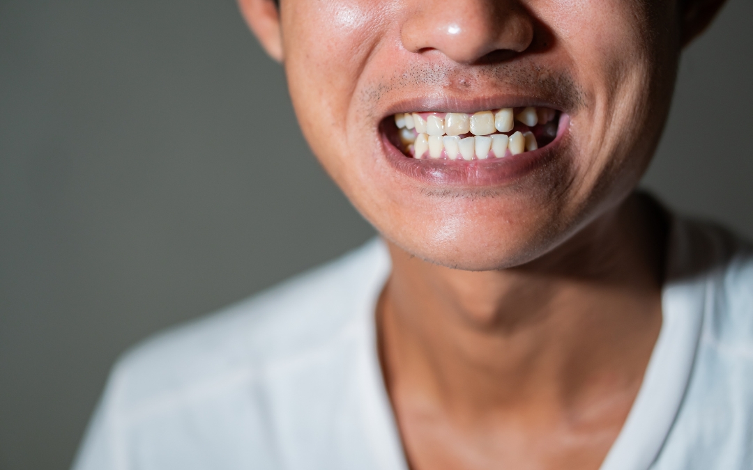 The Gap Between Your Dental Crown And Gums How To Fix It The Gap Between Your Dental Crown And Gums How To Fix It