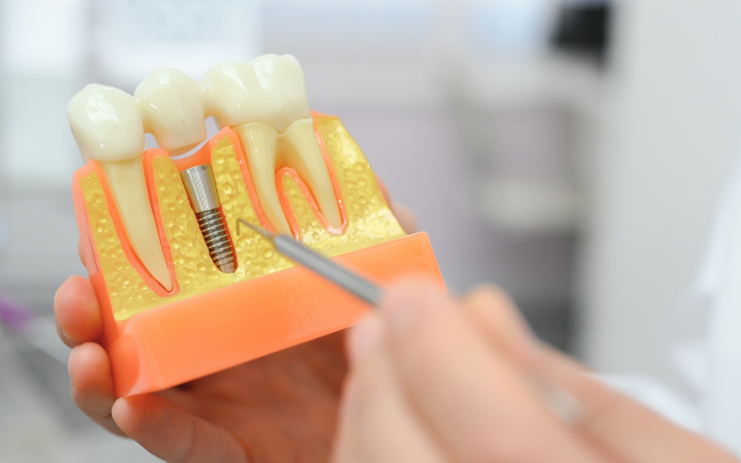 What Are the Most Common Reasons Dental Implants Fail What Are the Most Common Reasons Dental Implants Fail