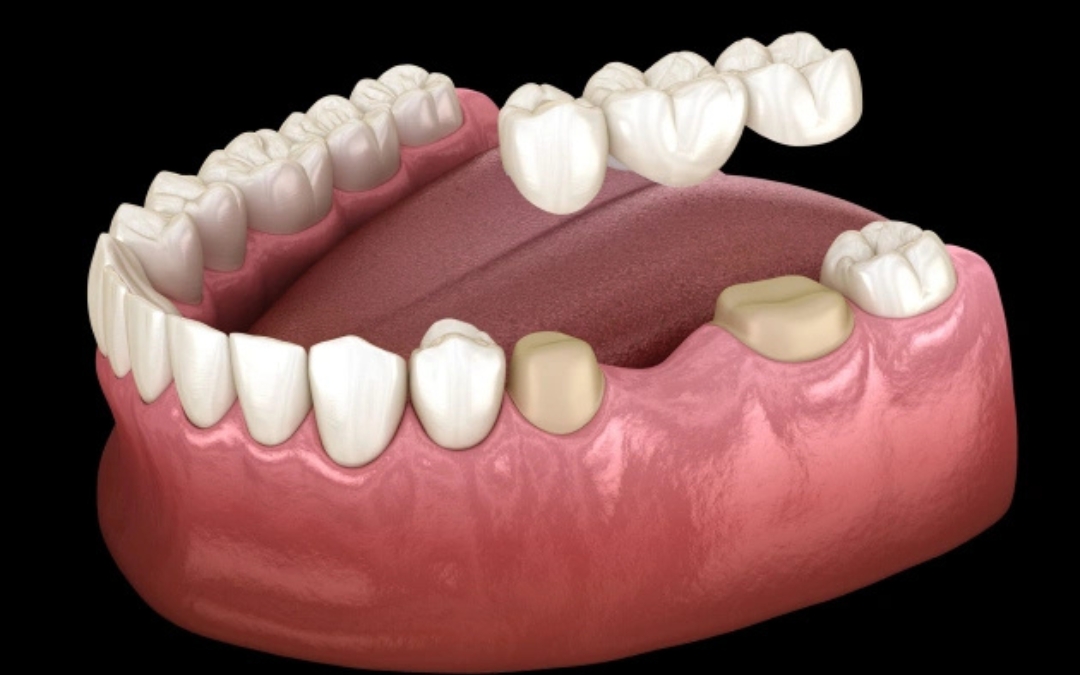 5 Immediate Actions to Take When a Dental Bridge Falls Out