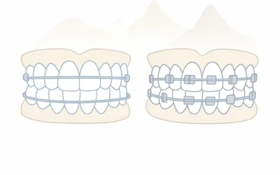 Invisalign vs. Traditional Braces: Which Is Right for You in Provo?
